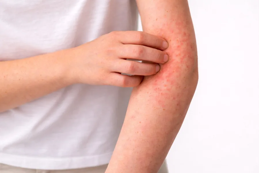 Dermatitis y urticaria